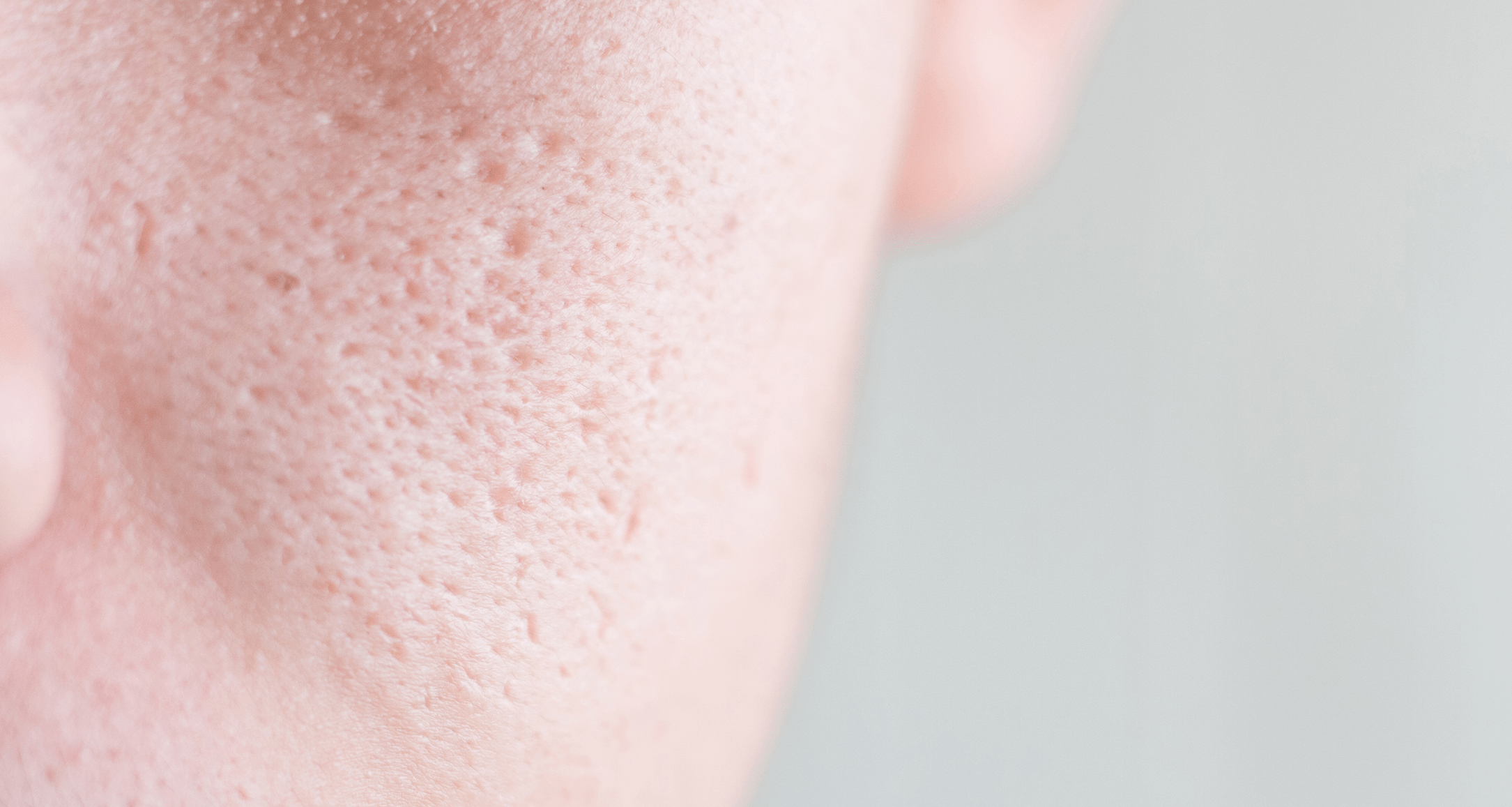 Close up of clogged pores