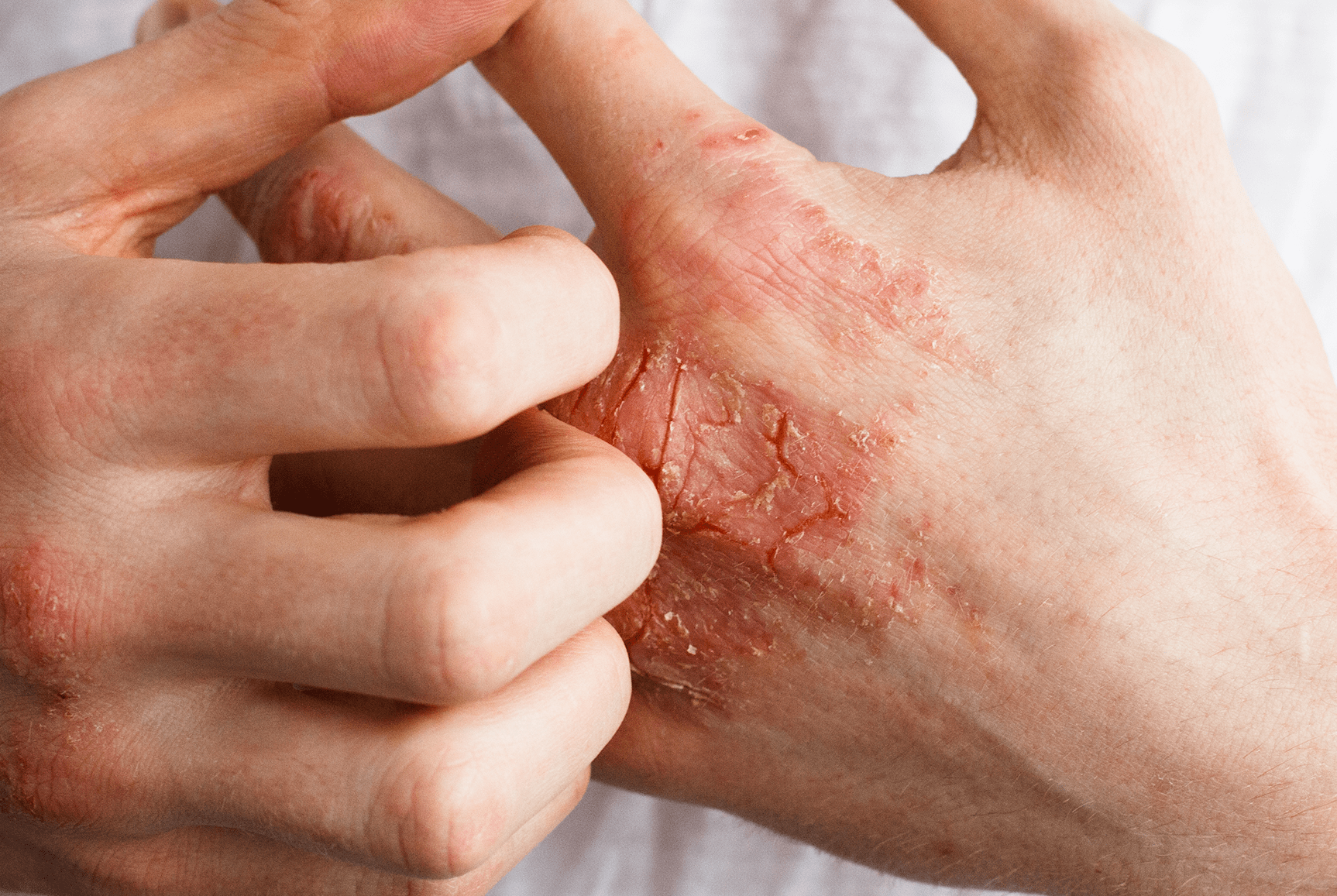 ekzém na rukou