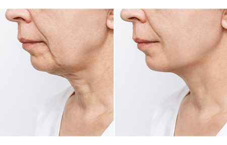 The lower part of a woman’s face before and after the treatment with hyaluronic acid.