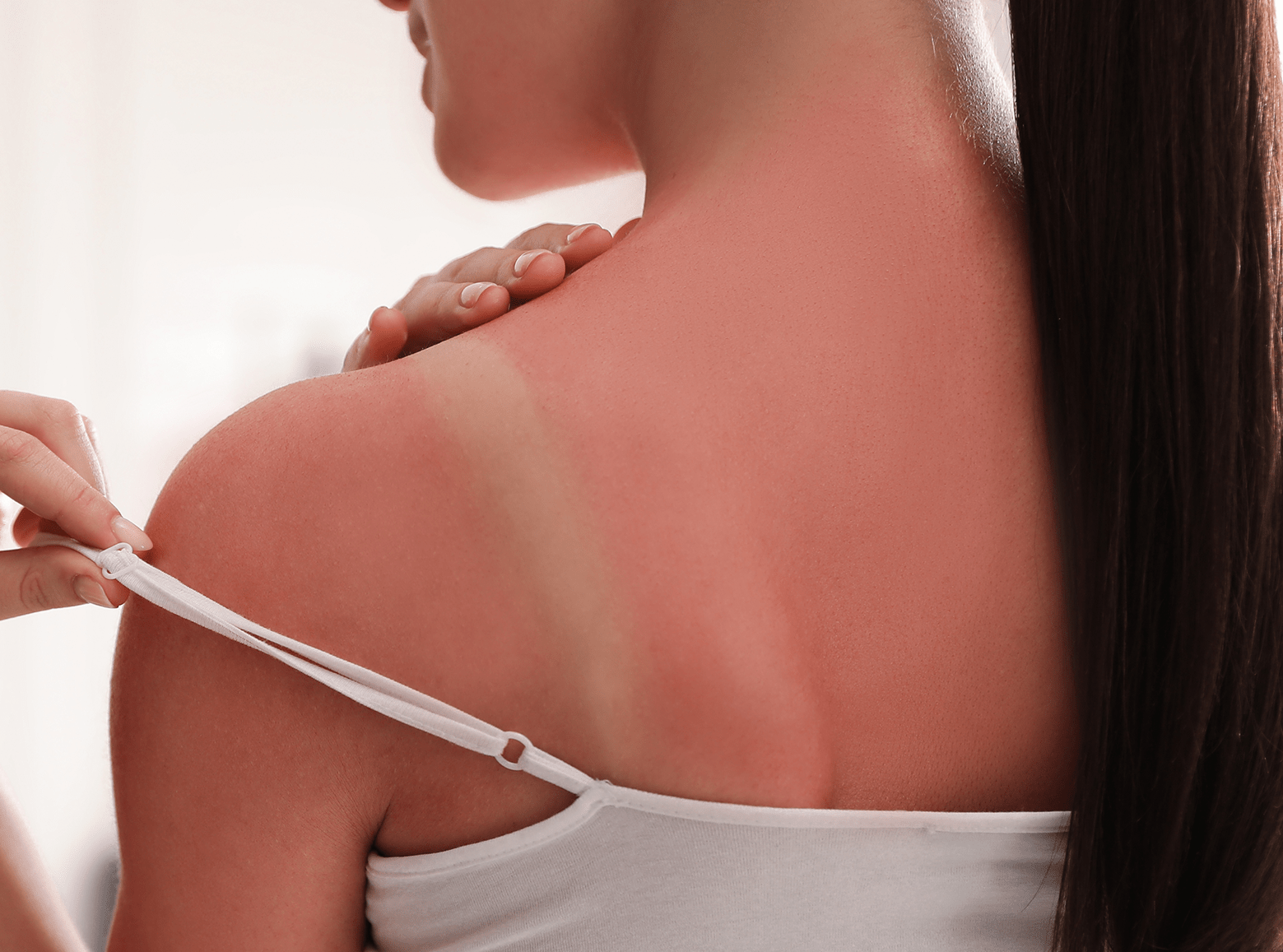 Kvinna som bränt sig i solen