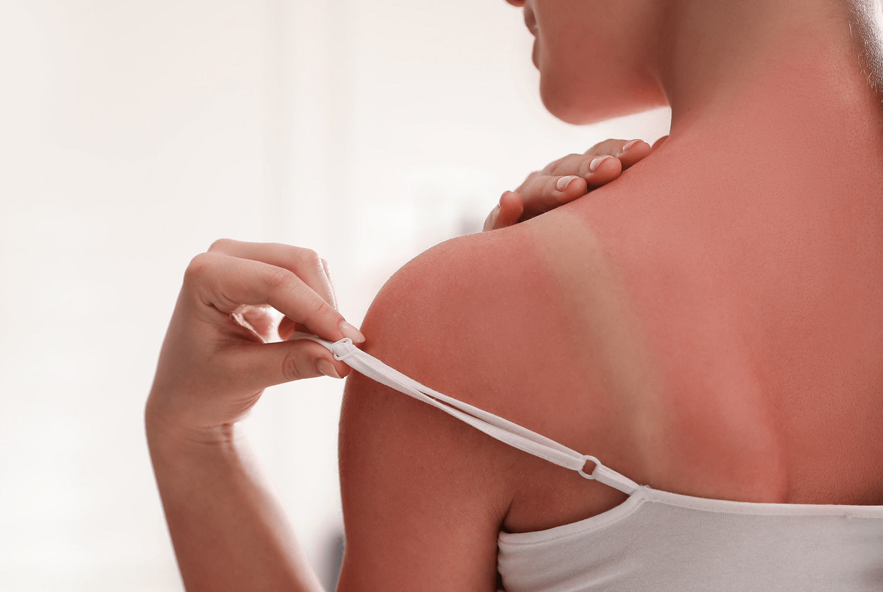Femme présentant des marques de coup de soleil