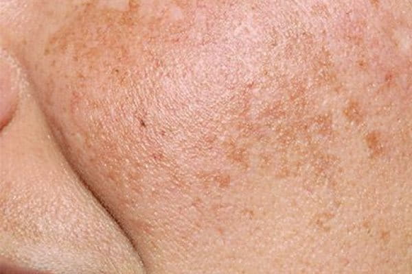 Bild på hud med hyperpigmenteringar som kan förebyggas med korrekt solskydd