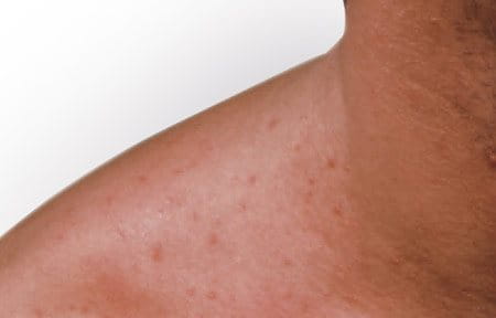Symptoms of Mallorca acne