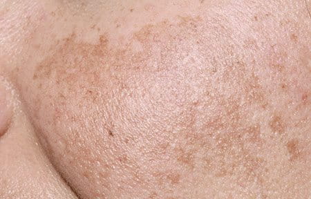 Close-up from female cheeks with melasma