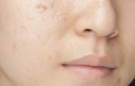 Woman´s face with oily and blemish skin