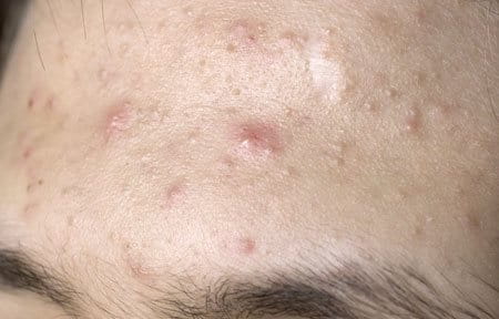 Close-up from forehead with acne symptoms