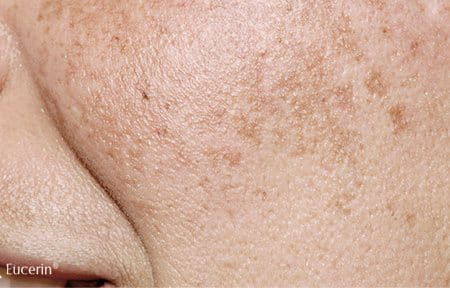 Close-up from female cheek with Melasma