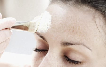 Chemical peel is applied on female forehead