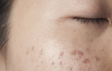 Chứng tăng sắc tố da sau viêm xảy ra dưới dạng các đốm da dẹt đổi màu.