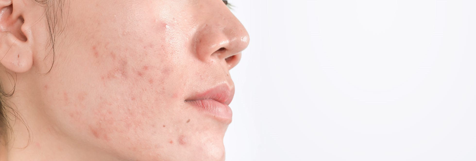 Hiperpigmentación post-inflamatoria del acné