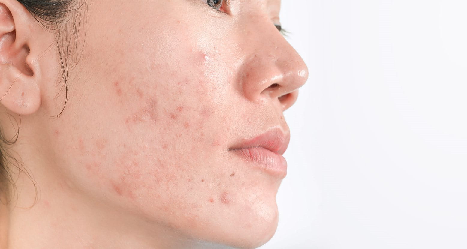 manchas en la piel por acne