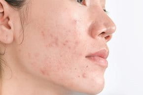 Post Inflammatory Hyperpigmentation Pih Eucerin