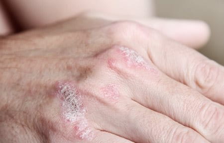Elderly hands with Psoriasis symptoms.