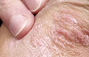 egészség pikkelysömör kezelése népi gyógymódokkal a naptól a bőrt vörös foltok borítják