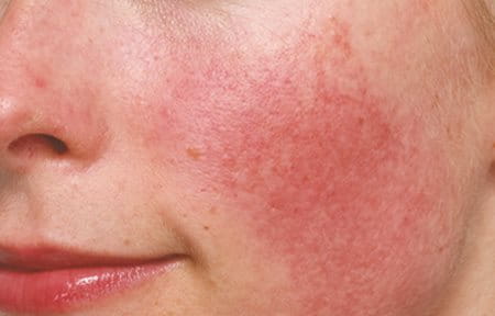Diffuse redness on a woman's face.