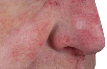Close-up of man's nose with rhinophyma.