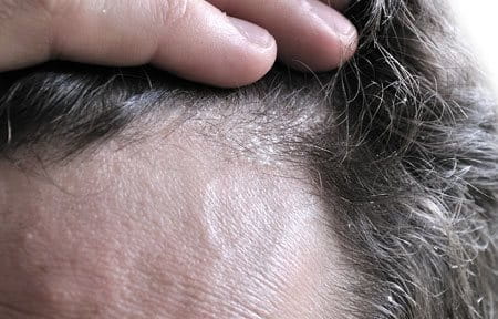 Acerca de piel | Dermatitis seborreica