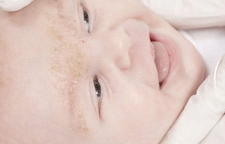beba sa seboreičnim dermatitisom po čelu i obrvama