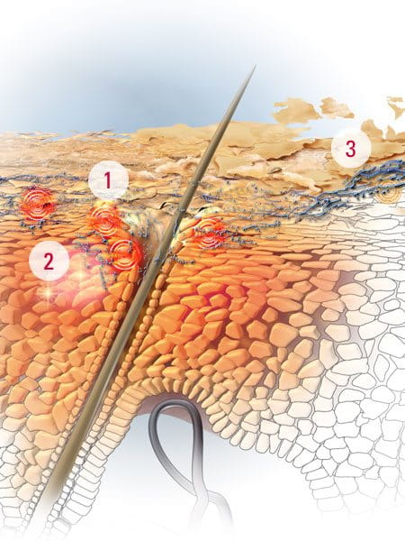 Признаци на себорейния дерматит 1. Хиперпролиферацията на кожата се предизвиква от гъбичката маласезия 2. Появяват се микровъзпаления по скалпа 3. Формират се видими люспи 