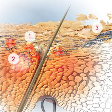 tekenen van seborroïsch eczeem