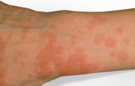 reazione fotoallergica che causa una dermatite da farmaci