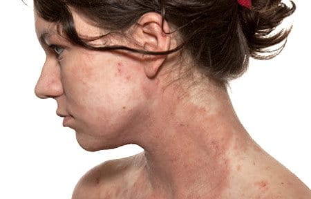 osoba s atopijskim dermatitisom