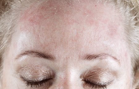 Woman´s forehead looking red and flaky.