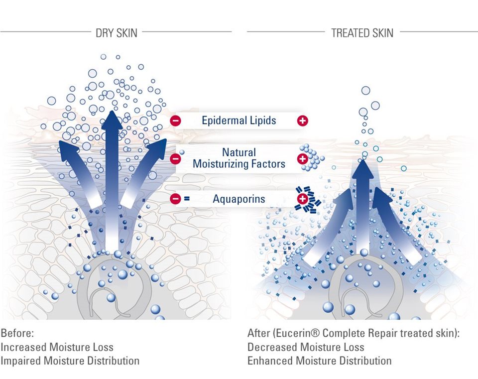 Xerosis Symptoms, Causes And Treatments Eucerin