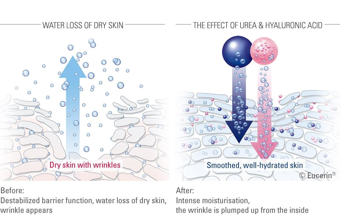 Illustration of the effect of Urea and Hyaluronic acid on skin