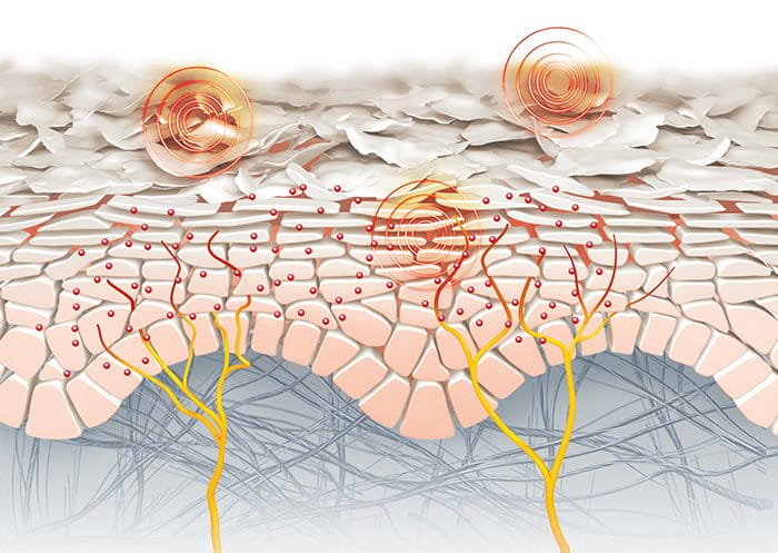 Illustration showing hyperactive skin cells lead to an itching sensation