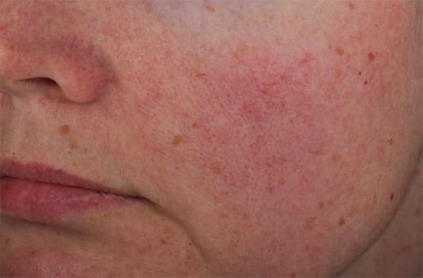 Photographs to show in Vivo study results on efficacy of AntiREDNESS Soothing Care