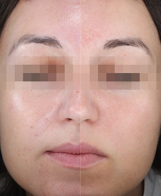Eucerin-aurinkosuojatuote rasvoittuvalle, akneen taipuvaiselle kasvojen iholle: Testi ennen ja jälkeen