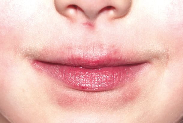 Lips before treatment with Eucerin Acute Lip Balm