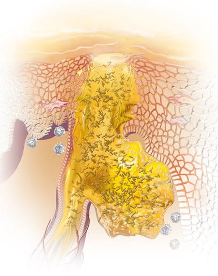 Graphic illustration of acne.