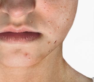 adolescente com acne