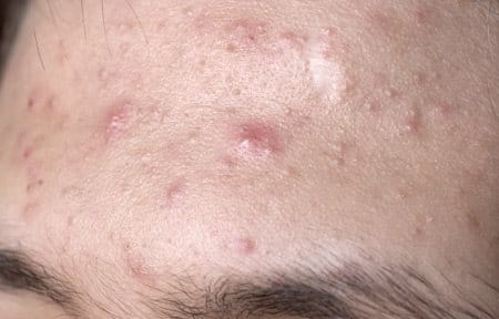 Forehead with acne