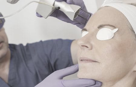 laserski tretman kože lica