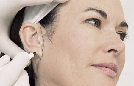 Une femme subit une chirurgie plastique du visage