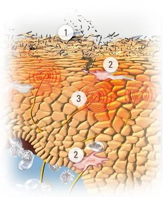 Atopic Dermatitis on body in children