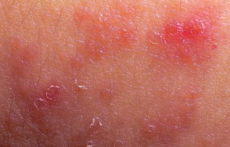 Atopic dermatitis on children skin