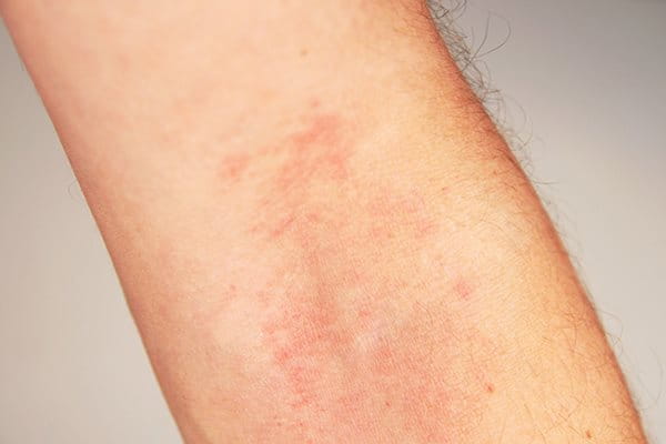 prikaz kože s atopijskim dermatitisom