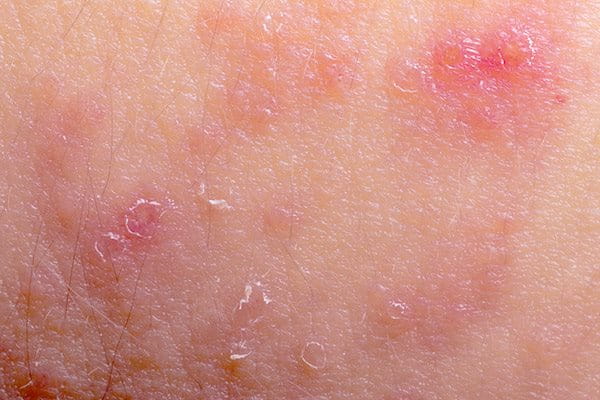 crvenilo kože s atopijskim dermatitisom