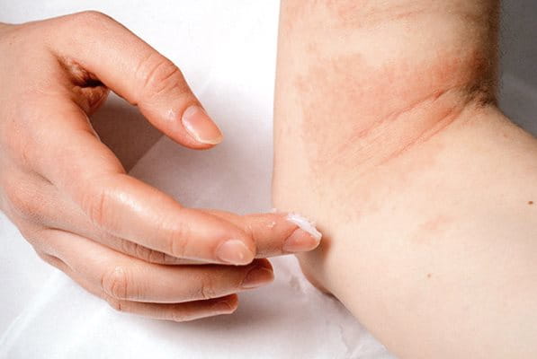 Finger som kliar på en atopisk hud med utbrott