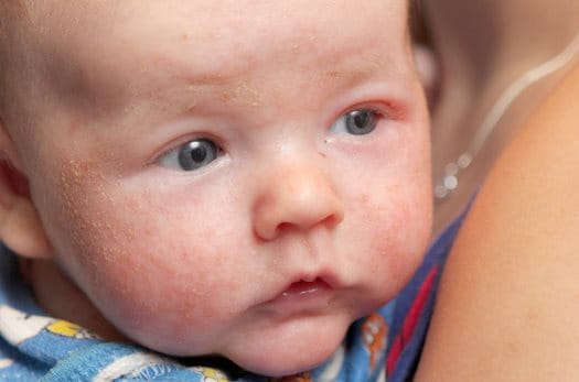 baby eczema on face