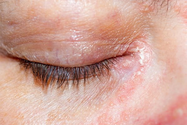 Atopická dermatitida okolo očí 