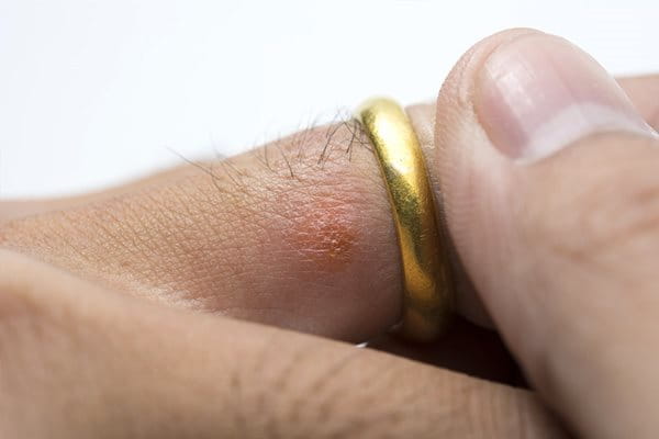 Alergická kontaktná dermatitída a šperky