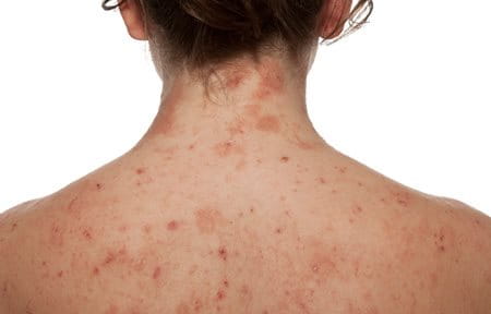 Woman´s back with infected skin.