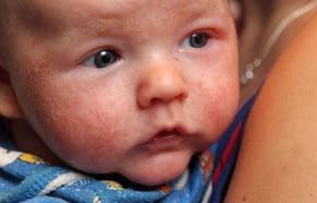 Atopic Dermatitis On Children Babies Face Eucerin
