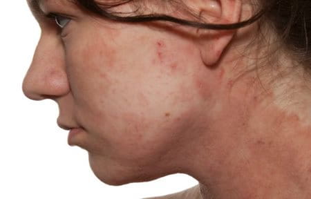 eucerin_atopic_dermatitis_face