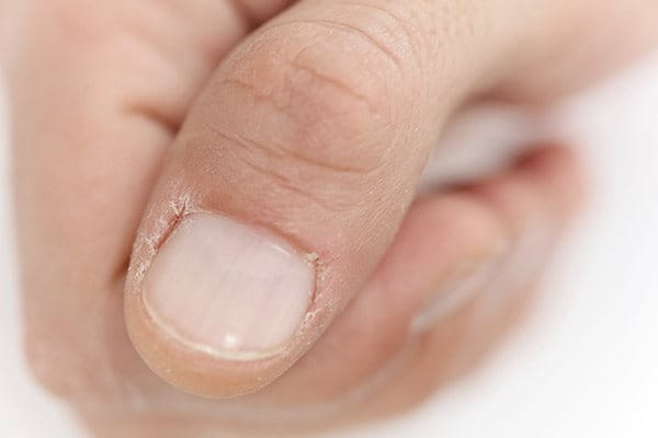 Cracked skin around finger nail